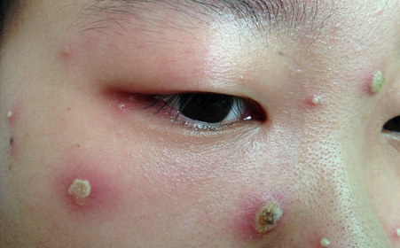 学习水痘预防知识